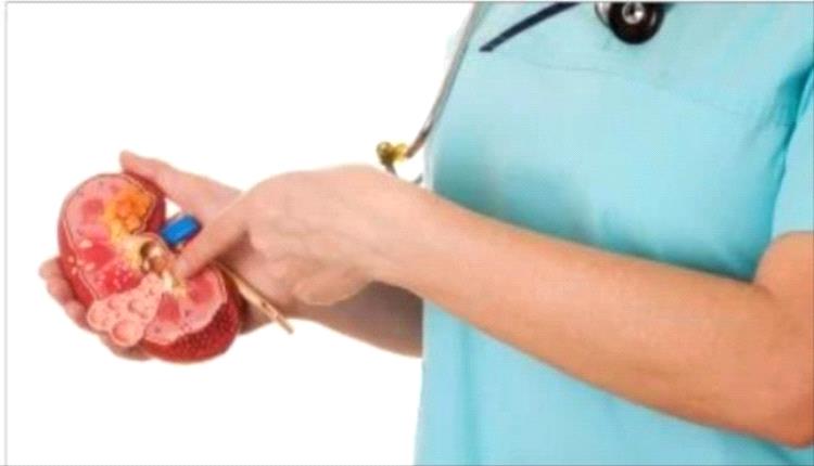 لماذا تزداد حالات الإصابة بحصوات الكلى بين الشباب