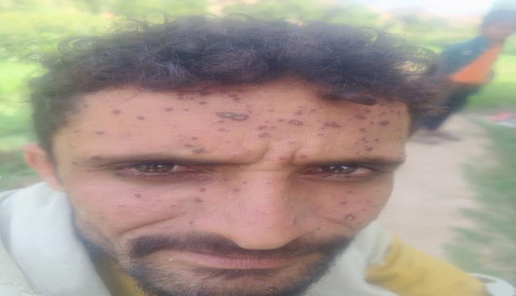 عشرات الإصابات بمرض "الجدري" تجتاح منطقة بلاد الأحمدي بالأزارق